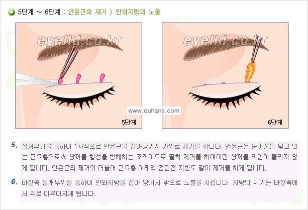 [두한성형외과 성형 FOCUS] - [퀵쌍꺼풀 수술 ③] 관련 이미지 8