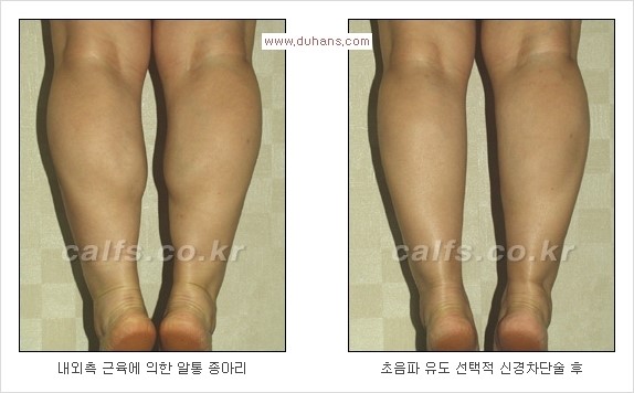 [두한성형외과 Dr. 컬럼] - [종아리 근육퇴축술로 가장 선호하는 비절개 초음파 유도 선택적 신경차단술] 관련 이미지 22