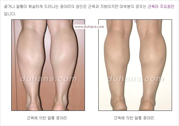 ⁠[두한성형외과 경쟁력 종아리성형] - [종아리퇴축술 - 비절개 초음파 유도 선택적 신경차단술 장비 안내] 관련 이미지 3