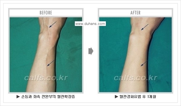 ⁠⁠[두한성형외과 정맥류 치료] - [손, 팔 정맥확장증 사진자료 안내 ②] 관련 이미지 2