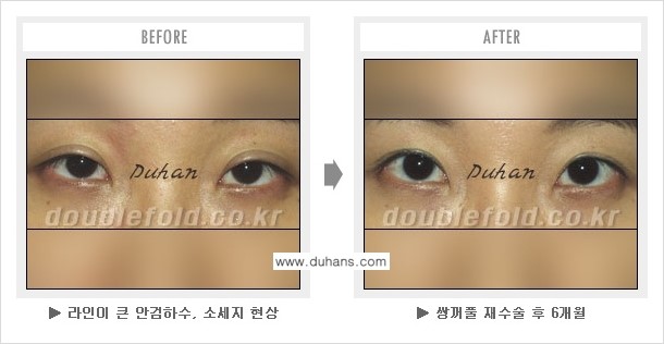 [두한성형외과 쌍꺼풀 재수술] - [눈매교정이 과한 경우의 문제] 관련 이미지 6