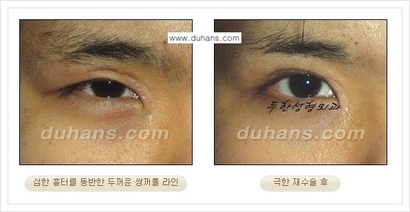 [두한성형외과 경쟁력 망가진 눈 복원수술] - [두꺼운 라인을 교정하는 극한 재수술(Extreme Reoperation) 안내] 관련 이미지 5
