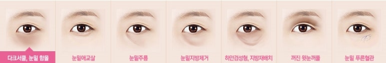 [두한성형외과 다크서클] - [다크서클 전후사진 검증] 관련 이미지 2