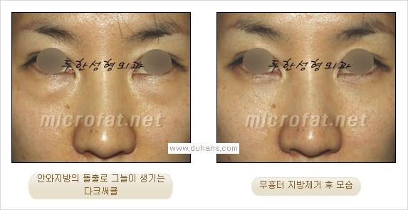 ⁠⁠[두한성형외과 경쟁력 안검성형] - [젊은 눈매를 위한 윗눈꺼풀 지방제거, 눈밑 지방제거] 관련 이미지 25