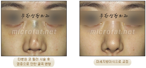 [두한성형외과 지방이식] - [지방이식을 이용한 코성형] 관련 이미지 22