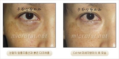 두한성형외과 눈밑수술 - 다크서클 수술 전후 관리 안내 관련 이미지 31