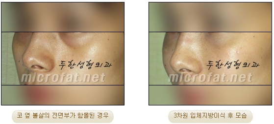 [Duhan Plastic Surgery Face Autologous Fat Grafting] - [Noble Surgery and Indian Band Fat Grafting] image 20