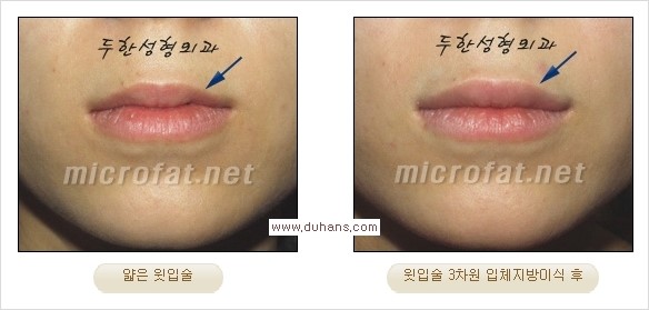 [두한성형외과 경쟁력 미세지방이식] - [입체 미세지방이식으로 주름을 펴면서 볼륨감 있는 입술 만들기] 관련 이미지 7