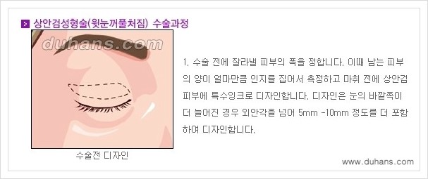 [두한성형외과 경쟁력 눈성형] - [상큼하고 환한 눈매! 상안검 성형(윗눈꺼풀 처짐) 안내] 관련 이미지 1
