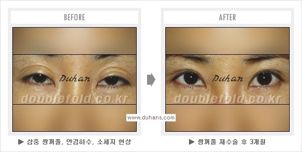 [두한성형외과 경쟁력 눈성형] - [삼중(세겹) 쌍꺼풀 라인의 교정] 관련 이미지 11