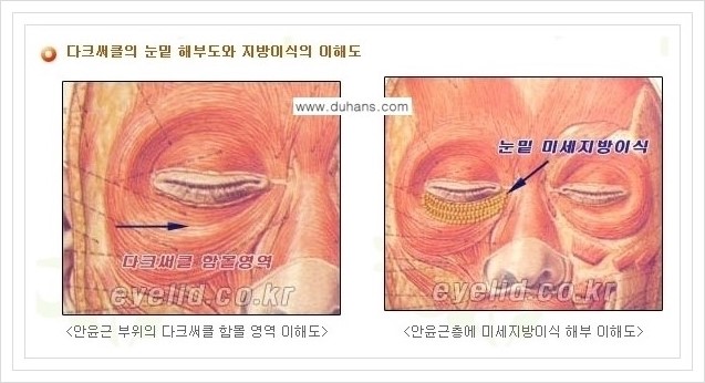 [두한성형외과 경쟁력 눈밑성형] - [눈밑 미세지방이식으로 다크써클 치료] 관련 이미지 3