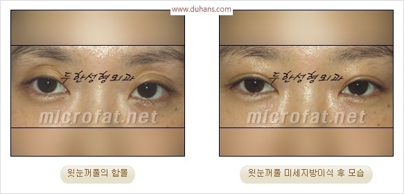 [두한성형외과 경쟁력 눈성형 리더] - [윗눈꺼풀 함몰( #꺼진눈꺼풀) 미세지방이식과 상안검성형]#꺼진눈성형 , #눈위함몰 관련 이미지 28