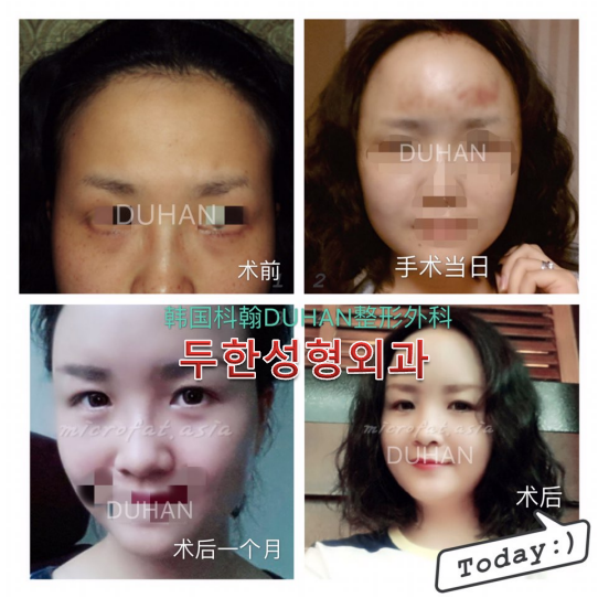 [두한성형외과]-[#이마지방이식 #관자지방이식 #측두부지방이식 #이마볼륨 #관자볼륨] 관련 이미지 1