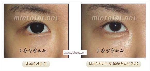 [두한성형외과 경쟁력 미세지방이식] - [애교살 필러 시술의 부작용 교정] 관련 이미지 12