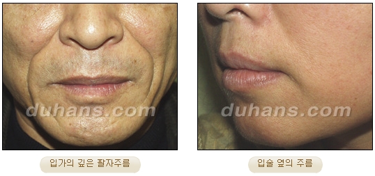 [Duhan Plastic Surgery Wrinkle Removal] - [Wrinkle Removal Treatment Methods] image 7