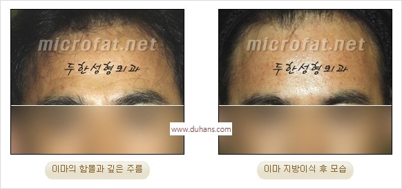 [두한성형외과 경쟁력 동안성형 리더] - ​[미간주름, 이마주름, 안검성형, 이마거상술, 눈썹거상술] 관련 이미지 37