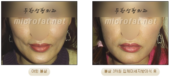 [두한성형외과 자가지방이식] - [미세지방이식 안내] 관련 이미지 15