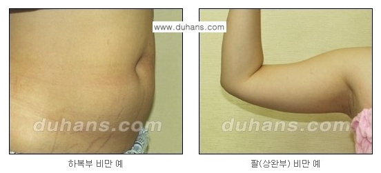 [두한성형외과 성형 FOCUS 간편 지방흡입] - [비만 탈출! 초음파 지방흡입 ①] 관련 이미지 2