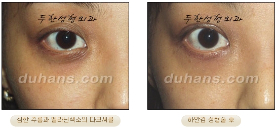 [Duhan Plastic Surgery Ophthalmic Plastic Surgery] - [Lower Blepharoplasty] image 24