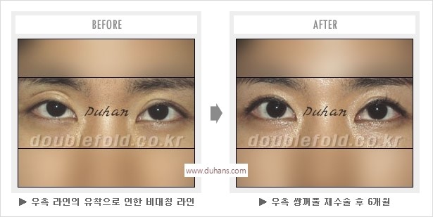 [두한성형외과 경쟁력 눈성형] - [나에게 맞는 어울리는 쌍꺼풀 라인] 관련 이미지 39