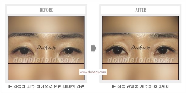[두한성형외과 경쟁력 눈성형] - [나에게 맞는 어울리는 쌍꺼풀 라인] 관련 이미지 38