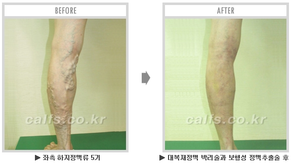 [종아리성형 두한성형외과] - [종아리수술에 대한 자주하는 질문과 답변 모음] 관련 이미지 17