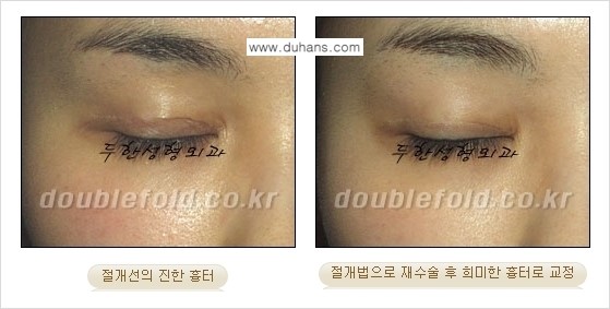 [두한성형외과 경쟁력 쌍꺼풀 재수술] - [흉터선이 진한 경우] 관련 이미지 8