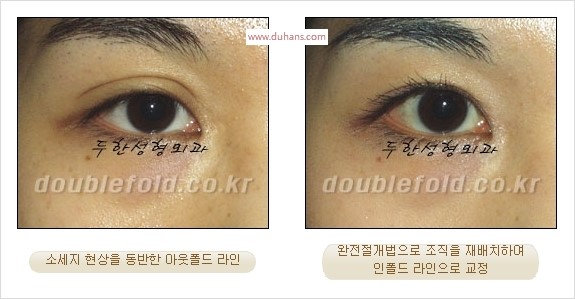 [두한성형외과 경쟁력 눈성형] - [완전절개법(Full incision method)의 재수술 과정] 관련 이미지 15