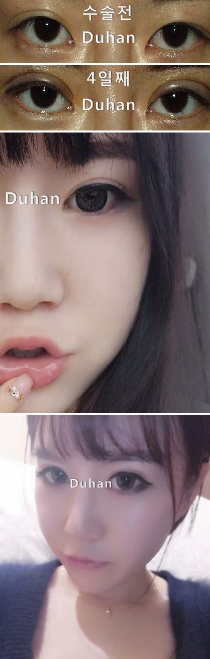 큰 아웃라인으로 #쌍꺼풀재수술 #아웃라인 #큰쌍꺼풀 #쌍수 #쌍커플 #쌍카풀 #쌍커풀 관련 이미지 1