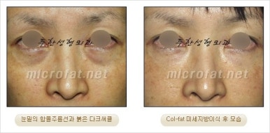 두한성형외과 눈밑수술 - 다크서클 수술 전후 관리 안내 관련 이미지 12
