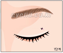 [두한성형외과 지방제거] - [눈두덩이지방제거, 눈밑지방제거] 관련 이미지 7