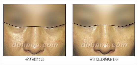 [두한성형외과 경쟁력 주름성형] - [세월의 흔적! 주름을 교정하는 여러 가지 교정 방법] 관련 이미지 20