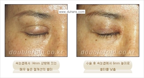 [두한성형외과 경쟁력 있는 쌍꺼풀 재수술] - [극복해야 할 극한의 상황과 문제들] 관련 이미지 3