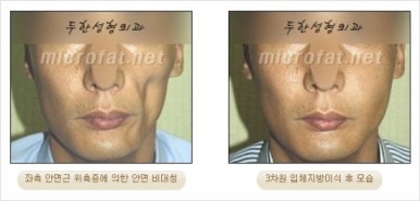 [두한성형외과 얼굴자가지방이식] - [지방이식 과정] 관련 이미지 41
