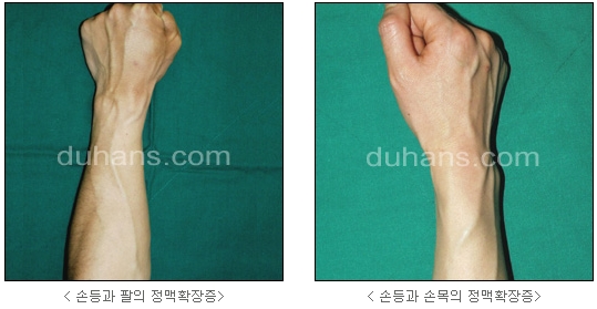 [두한성형외과 정맥류] - [하지정맥류, 정맥확장증, 혈관확장증] 관련 이미지 49