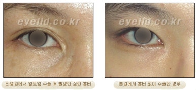 [Duhan Plastic Surgery Eyelid Surgery] - [Epicanthoplasty, Medial Canthoplasty] image 5