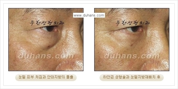 [두한성형외과 경쟁력 눈성형] - [젊은 눈매로의 복원 안검성형] 관련 이미지 32