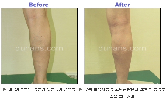 [두한성형외과 정맥류] - [하지정맥류, 정맥확장증, 혈관확장증] 관련 이미지 39