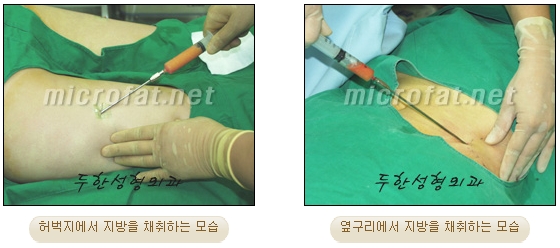 Fat Grafting Leader Duhan Plastic Surgery - Everything About Fat Grafting image 58