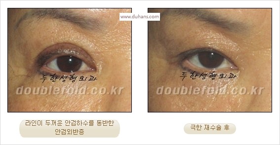 [두한성형외과 경쟁력 쌍꺼풀 재수술 스페셜] - [망가진 라인을 교정하는 극한 재수술] 관련 이미지 11