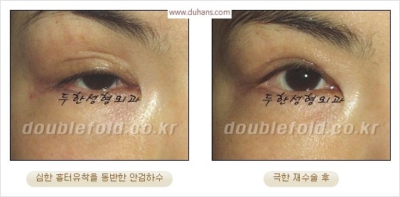 [두한성형외과 경쟁력 눈성형] - [극한 재수술, 함몰된 눈꺼풀 라인교정, 안검하수(졸리운 눈매)] 관련 이미지 19