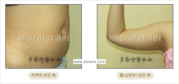 [두한성형외과 겨울엔 지방흡입 도전] - [간편한 복부지방흡입 1.] 관련 이미지 1