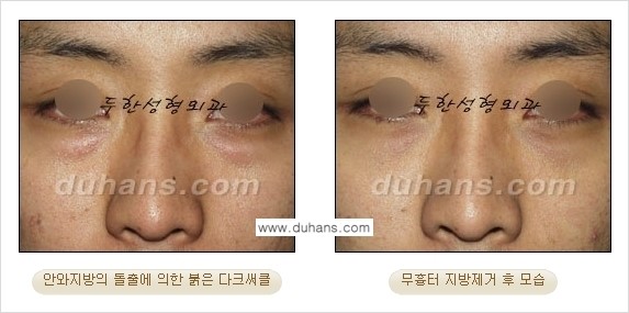 [두한성형외과 젊은 눈매 안검성형] - [눈밑 지방제거의 수술 전후 안내 ②] 관련 이미지 18