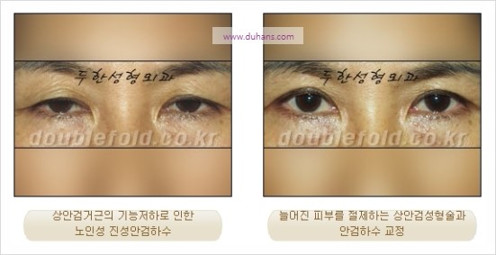 [두한성형외과 경쟁력 눈성형] - [극한 재수술, 함몰된 눈꺼풀 라인교정, 안검하수(졸리운 눈매)] 관련 이미지 88