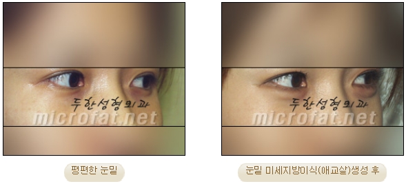 [두한성형외과 미세지방이식] - [자가지방이식] 관련 이미지 11