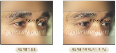 [Doohan Plastic Surgery Autologous Fat Grafting] - [Sunken Eye Fat Grafting] image 28