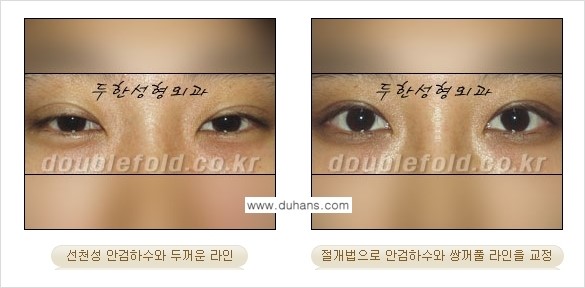 [두한성형외과 NO.1 "극한 눈(쌍꺼풀 재수술)"] - [안검하수(졸린눈매) 재수술 안내 3.] 관련 이미지 3