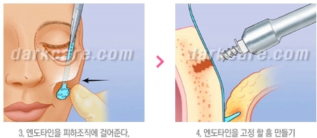 Duhan Plastic Surgery Combo Program - Dark Circles and Lifting image 33