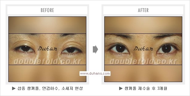 ⁠[두한성형외과 경쟁력 쌍꺼풀 재수술, 극한 눈재수술] - [삼중(세겹) 쌍꺼풀 라인의 교정] 관련 이미지 3
