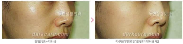[두한성형외과 자가지방이식] - [인디언주름] 관련 이미지 27